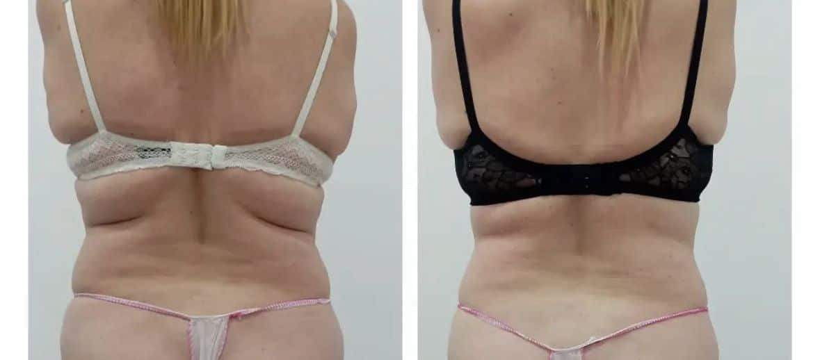 Antes / Después: Bellaction Duo corporal: espalda y cintura más estilizadas