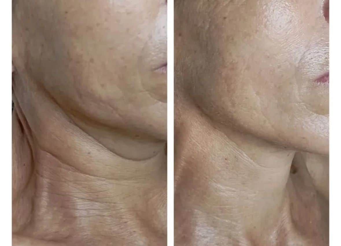 Antes / Después: Bellaction Duo facial: cuello y mandíbula con aspecto más firme