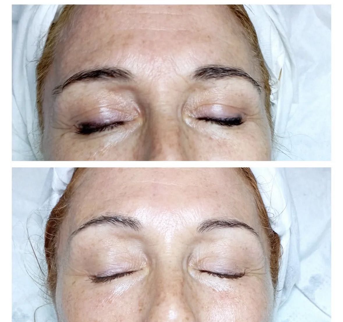 Antes / Después: Bellaction Duo facial: mirada más descansada y párpado con efecto lifting