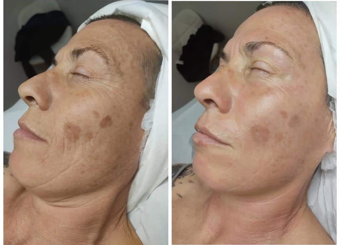 Antes / Después: Dermapen: manchas de la mejilla visiblemente atenuadas