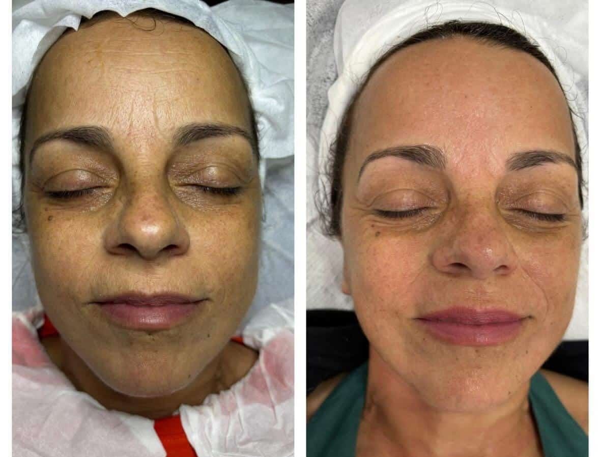 Antes / Después: Dermapen: reducción de la hiperpigmentación y piel más luminosa