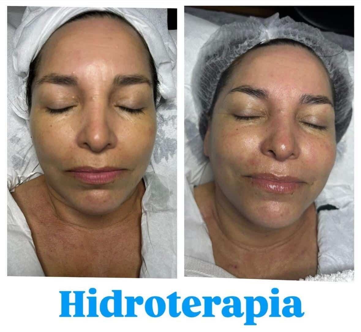 Antes / Después: Hidroterapia facial: piel más limpia y luminosa