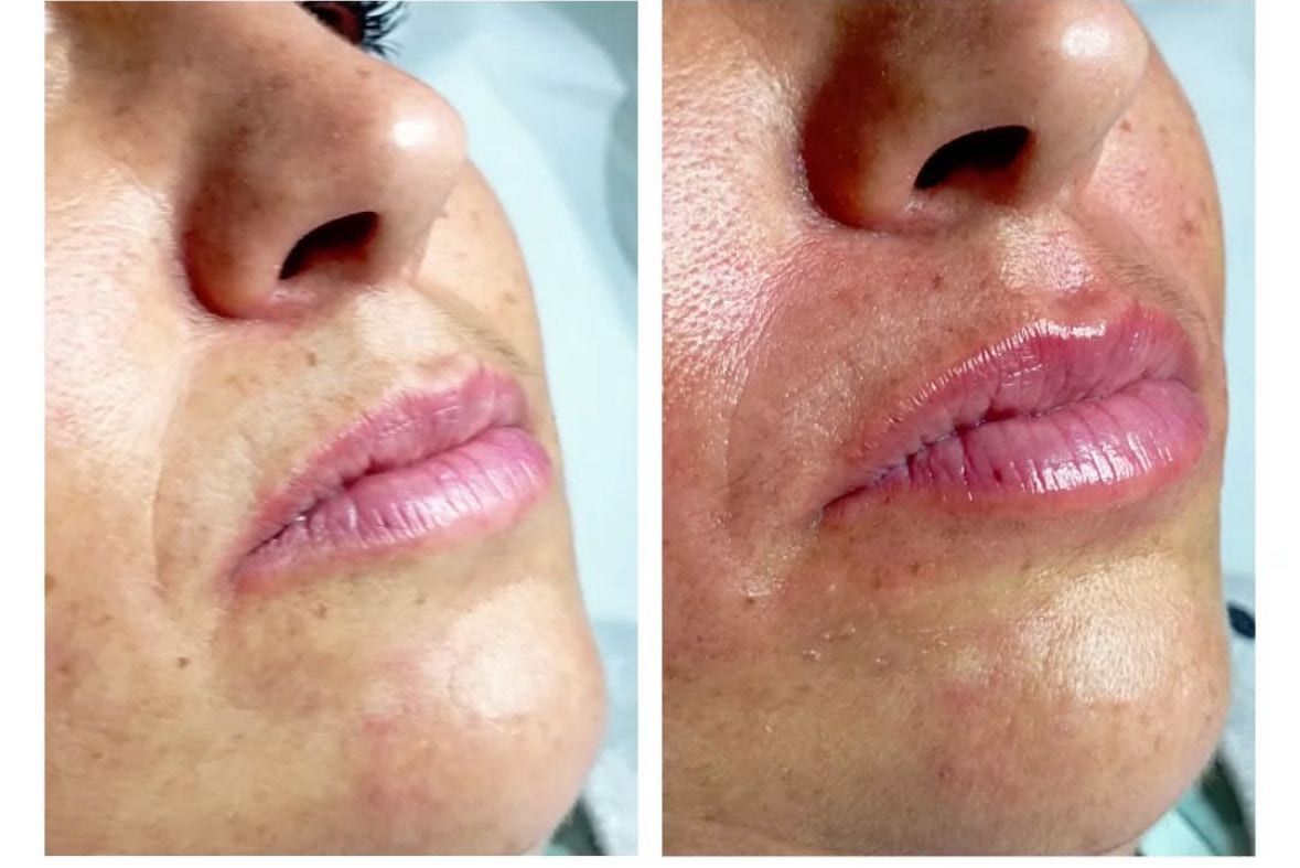 Antes / Después: Hidratación de labios: labios más jugosos y definidos