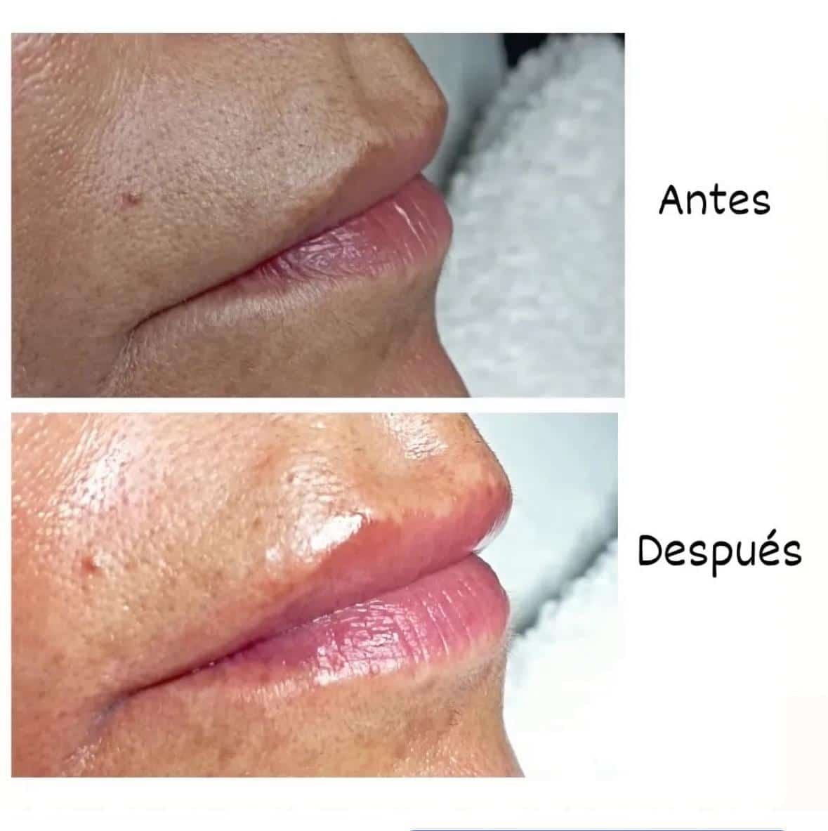 Antes / Después: Hidratación de labios: más volumen e hidratación